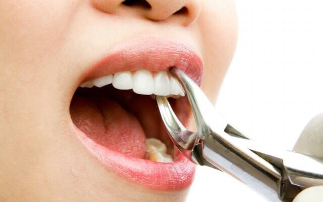 выдаленне зуба і ўжыванне алкаголю