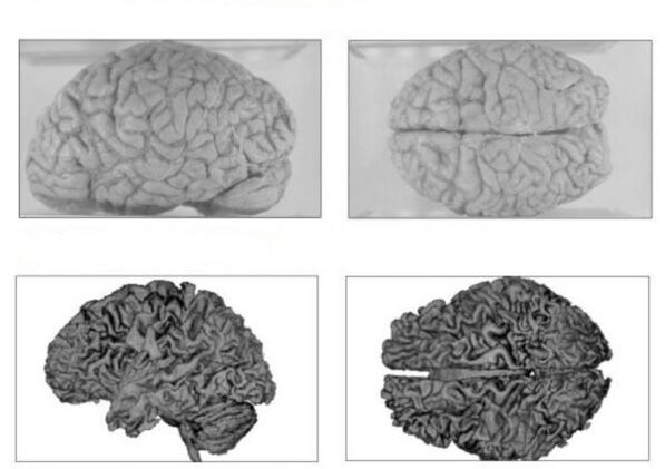 Мозг здаровага чалавека (зверху) і мозг алкаголіка з незваротнымі наступствамі (знізу)